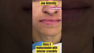 Class 3 malocclusion with anterior cross bite and prognathic jaw [upl. by Hokanson]