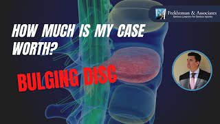 How Much Is A Herniated Disc Worth Whats My Case Worth Series [upl. by Brear]