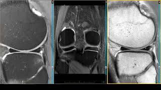 Meniscus  Medial Intrameniscal Tear [upl. by Nohsyar]