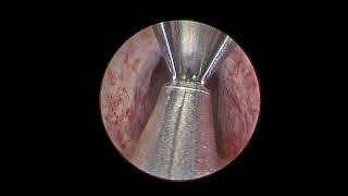 Urolift Procedure  Dr Singh [upl. by Einavoj]