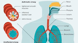 Pathogenesis of Asthma simplified [upl. by Aushoj]