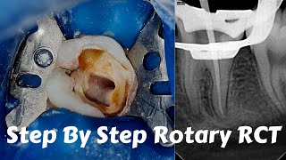 Live Steps Root Canal Rotary Protaper Endodontic Procedure ACP BMP obturation irrigation [upl. by Lilias]