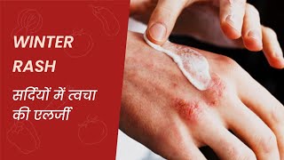 WINTER RASH  सर्दियों में होने वाली त्वचा की एलर्जी कारण सावधानी और उपचार skincare aesthetic [upl. by Otreblig628]