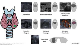 Thyroid Nodules [upl. by Natsirt]