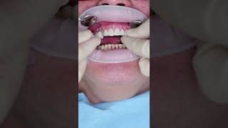 Dental veneers in Prague shorts dentist dental veneers short [upl. by Monroe]