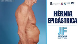 HÉRNIAS ABDOMINAIS Parte 4 EPIGÁSTRICA 👨🏽‍⚕️🚑 Joao Fonseca Cir Geral [upl. by Showker]