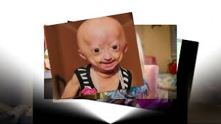 Youtuber Adalia Rose Texas star dies at 15 from rare medical condition [upl. by Bassett132]