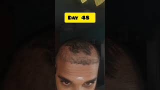 Hair transplant day 48UltraBioHairTransplantClinic hairtransplant barbershophairlinetransplant [upl. by Kary502]