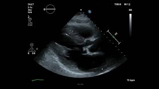 Transthoracic echo showing an aortic valve vegetation [upl. by Luigi]