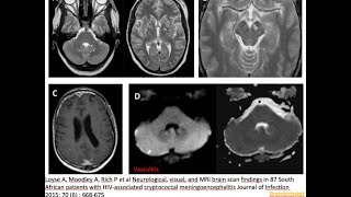 33 CNS cryptococcosis gelatinous pseudocyst HIV AIDS opportunistic infection MRI imaging [upl. by Elleuqram]