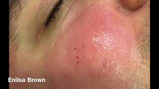 Christians Acne Treatment  Blackheads Extractions [upl. by Sirrah652]