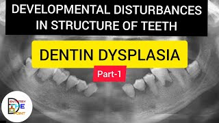 DENTIN DYSPLASIA ROOTLESS TOOTH PART1 Developmental Disturbances of structure of teeth [upl. by Alhan709]