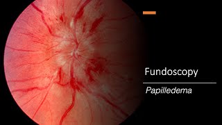 Papilledema Fundoscopy [upl. by Jermaine]