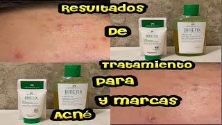 Resultados de Tratamiento Biretix Gel para espinillas y marcas de acné [upl. by Argela]