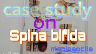 Case study on Spina bifida meningocile pediatric Case plan on Spina bifida meningocile ncp [upl. by Ragland630]