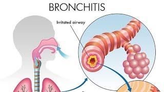 BRONHITISI medicina inflamacion mjekesi mushkerit bronchitis [upl. by Teriann]