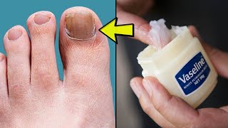 TOENAIL FUNGUS TREATMENT How To Get Rid of Toenail Fungus At Home Fast and Naturally [upl. by Zeculon]