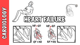 Heart failure with reduced and preserved ejection fraction pathophysiology and treatment [upl. by Verdi]