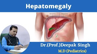 Hepatomegaly Enlargement of liver  Deepak PD Singh [upl. by Chang]