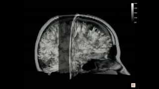 3D rendering of whole brain fiber tracking [upl. by Eeliram]