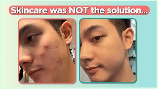 Confused sa pag treat ng ACNE Start here Beginners Guide  Jan Angelo [upl. by Greyson]