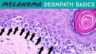 Melanoma vs Nevus Microscopic Clues for Malignancy Explained in 5 Minutes [upl. by Sesilu]