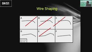 Antegrade Wire Escalation amp Parallel Wire Technique by Dr Kaisar nasrullah khan [upl. by Aremihc]