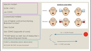 Caloric Testing Vestibulooccular relfex [upl. by Merlin673]