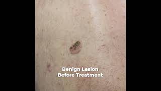 Benign Lesion Treatment Fotona Erbium Laser [upl. by Nomolas]