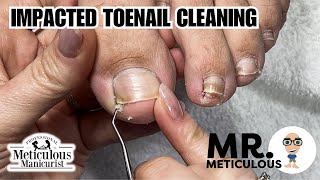 How to Fix Ingrown  Impacted Toenails at Home nails satisfying [upl. by Bohaty]