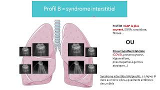 3 Pneumopathies syndromes interstitiels et pleurésie [upl. by Celeste]