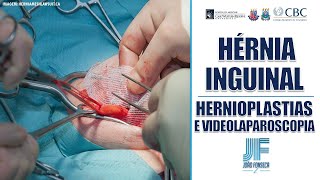 HÉRNIAS ABDOMINAIS Parte 9 INGUINAL HERNIOPLASTIAS E VIDEO 👨🏽‍⚕️🚑 Joao Fonseca Cir Geral [upl. by Lynette]