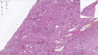 Benign Nephrosclerosis  Histopathology [upl. by Wei]