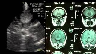 VSCAN Intraoperative quotpocketquot ultrasound Cerebellar Vermis Medulloblastoma [upl. by Cai]