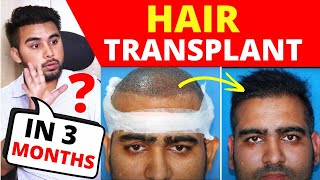 Comparing 3 Hair Transplant Results Of 4 Months  How Hair Looks Like 4 Months After Hair Transplant [upl. by Alamac]