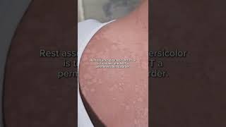 Pityriasis Versicolor What You Need to Know [upl. by Drofxer]