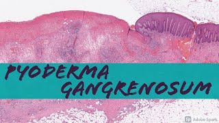 Pyoderma Gangrenosum vs NonSpecific Chronic Ulcer Changes [upl. by Erreipnaej]