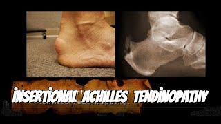 Why Achilles Tendinopathy Happens and How to Fix It [upl. by Joann712]