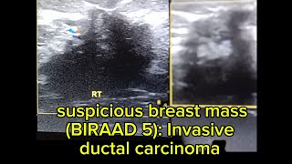 ultrasound of suspicious breast mass BIRAD 5 Invasive ductal carcinoma [upl. by Gigi19]