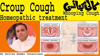 Croup cough and whooping cough treatment in homeopathy [upl. by Aennyl966]