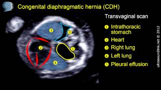 Congenital diaphragmatic hernia CDH at 12 weeks gestation [upl. by Verla]