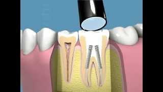 Tutti i passaggi della terapia canalare e della capsula dentale [upl. by Llemert]