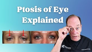 Ptosis of the Eye Explained  Eyelid Surgery for Droopy Eyelids [upl. by Morra]