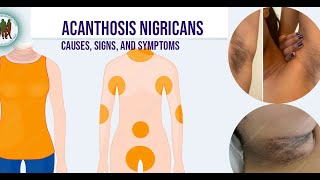 Acanthosis Nigricans Causes Signs and Symptoms [upl. by Limaj30]