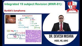 🕉 Integrated 19 subject Revision INR81 Burkitts lymphoma by Dr Devesh Mishra [upl. by Htebizile]