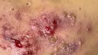 SEVERE CYSTIC ACNE Removal 😲 Crusty Scabs on Cheeks Hana Spa [upl. by Geer]