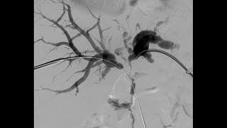 Percutaneous Transhepatic Cholangiography and Drainage PTCD [upl. by Alleyne881]