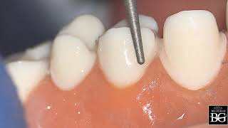 Stepbystep crown preparation for upper premolar Препарирование под коронку верхнего премоляра [upl. by Carmelle]