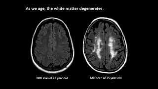 The Aging Brain  Week by Week Time Lapse [upl. by Ardie]