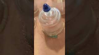 Cupping therapy for back stiffness after operation bestphysiotherapy [upl. by Nollad]